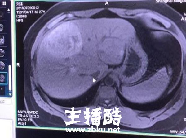 沈灵敏透露PDD近况：会回来直播 病情已确认为良性